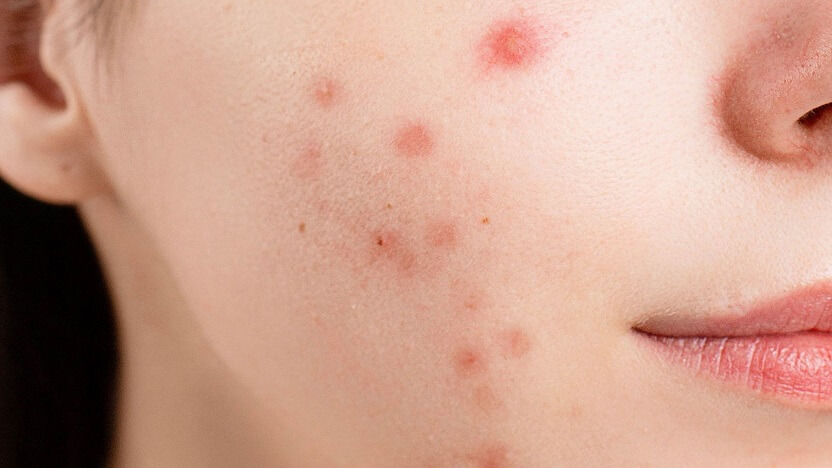 Natural Ways to Get Rid of Pimples as Fast as Possible