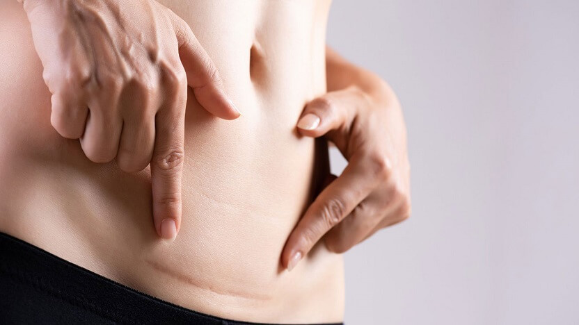 hacks to remove all types of scars and help them heal